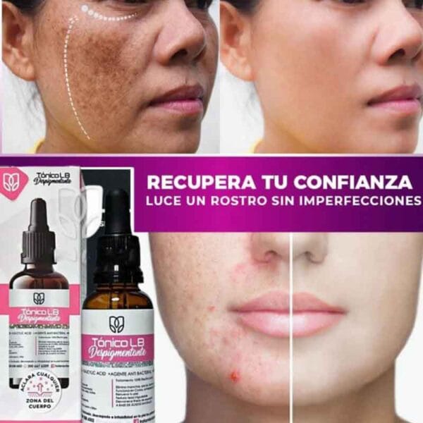 Tónico Quita Manchas Contra El Acné y Aclarante De Piel - Image 4